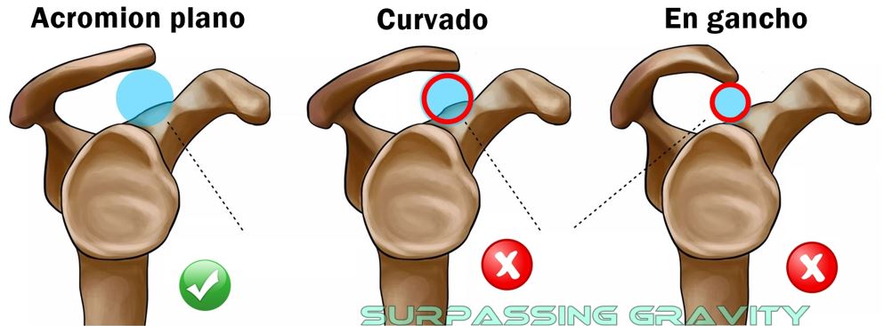 Tipos de acromion
